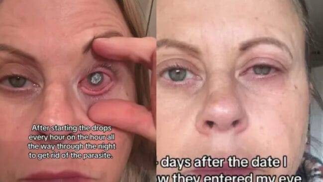 O uso inadequado de lentes de contato pode facilitar infecções graves, como a ceratite causada pelo parasita Acanthamoeba (Reprodução: Kennedy News/ emsie.finds)