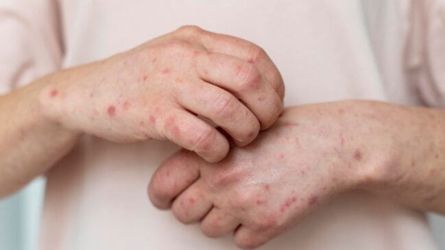 Vacina tríplice viral protege contra sarampo, caxumba e rubéola e está disponível gratuitamente nas unidades de saúde