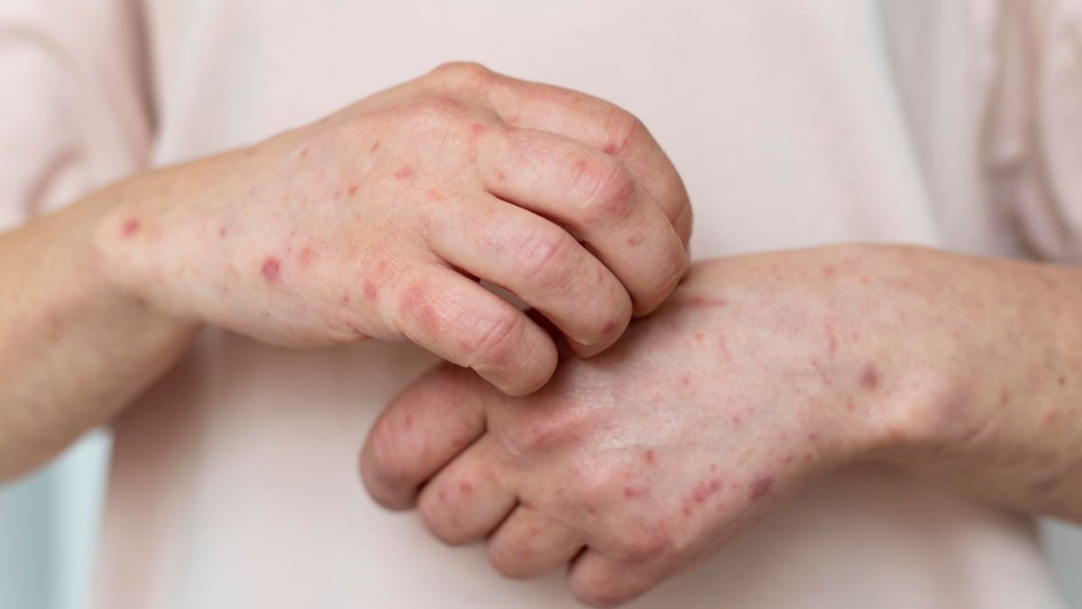 Vacina tríplice viral protege contra sarampo, caxumba e rubéola e está disponível gratuitamente nas unidades de saúde