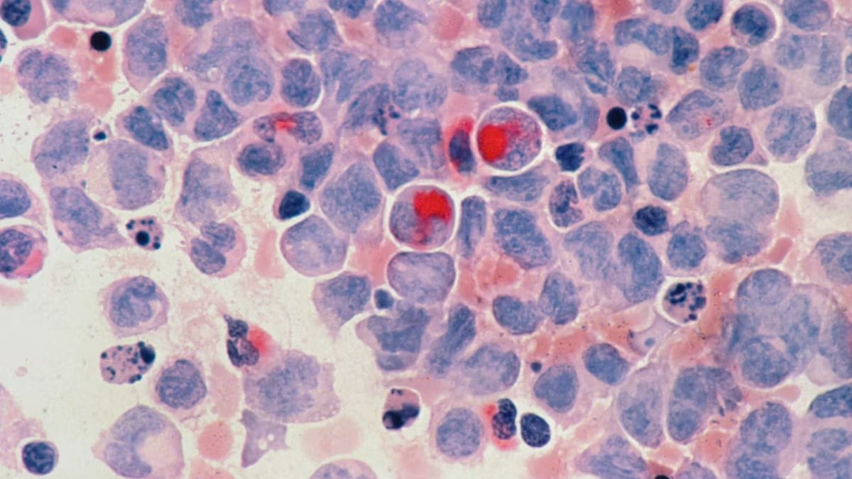 linfoma não Hodgkin