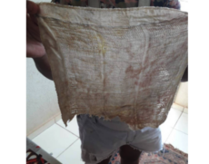 Mulher mostra pano deixado em seu intestino
