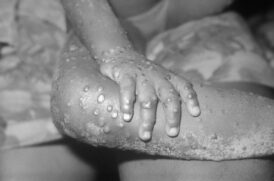 Quadros graves estão relacionados ao surgimento de pneumonia, sepse, encefalite e infecção ocular