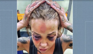 Fotos mostram hematomas por todo o corpo da jogem