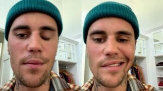 Justin Bieber gravou stories mostrando seu rosto paralisado
