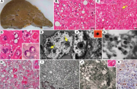 Patologia da infecção grave pelo SABV. Imagens mostram fígado danificado e detalhes do vírus