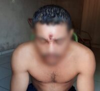 Homem foi baleado na testa e mesmo assim resolveu ir para casa tirar uma soneca