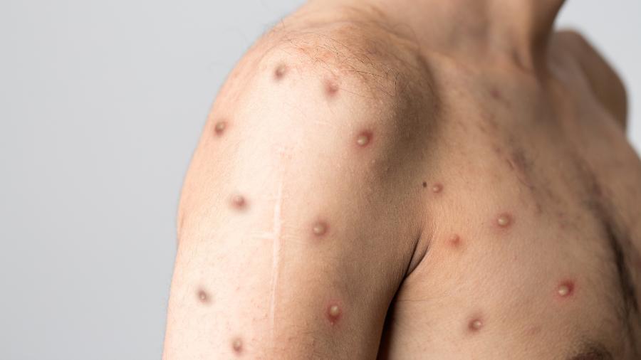 Segundo a Anvisa, o teste é fabricado pela Fiocruz e se destina ao diagnóstico e vigilância epidemiológica de orthopox, varíola dos macacos e varicella zoster.
