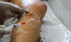 A doença é mais comum em pessoas idosas, obesas, sedentárias, fumantes, além das que possuem casos da comorbidade entre familiares e também em pacientes que ficaram muito tempo acamados devido a algum trauma.