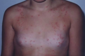 Mostra da dermatite em casos de prurido do traje de banho