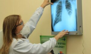 Segundo dados do governo, o Brasil concentra um terço dos casos de tuberculose nas Américas, com cerca de 72,6 mil novos casos por ano e 4,7 mil óbitos
