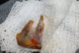 Frango fazia parte do almoço da paciente