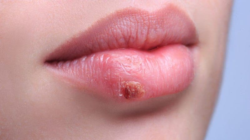 O vírus Herpes simplex tipo 1 é o causador do herpes labial, e muitas pessoas acham que a única forma de transmissão é o beijo, mas especialista aponta outras formas
