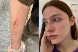 Frantiesca Albuquerque, 21, após agressão que, segundo ela, sofreu no último sábado (1°)