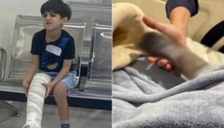 À esquerda, Yuri em primeiros atendimentos médicos, em Guarujá; à direita, pé gangrenado semanas depois