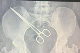 Pinça cirúrgica que estava dentro do corpo de uma diarista de 27 anos após cirurgia, há dois meses, em Araçatuba (SP) -