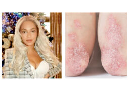 Beyoncé em anuncio feito pelo Instagram admitiu lutar contra a doença psoríase