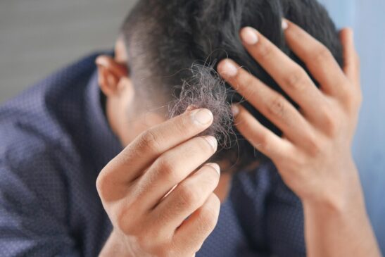 Quando ocorre uma queda de cabelo excessiva, é importante buscar o diagnóstico com um especialista