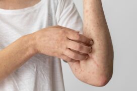 O Sarampo é uma doença muito comum e pode ser prevenida por meio da vacinação