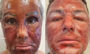 Peeling de fenol