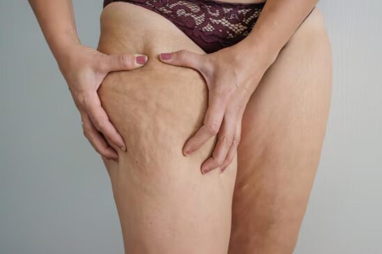Lipedema: saiba o que é e quais são os sintomas