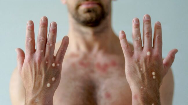 Mpox é uma doença transmitida aos humanos a partir de um vírus que circula entre animais