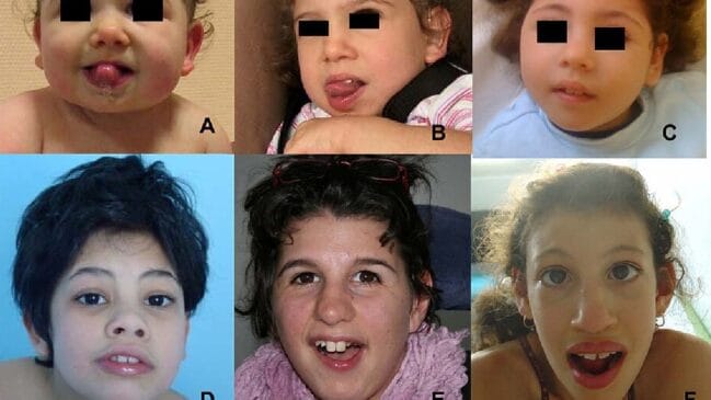 Por que algumas doenças genéticas são tão raras? A maioria das mutações nos genes não geram nenhuma mudança. Porém algumas combinações genéticas, como as hipoplasias pontocerebelares, são tão raras e tão catastróficas que a ciência ainda investiga qual são as relações de causa-efeito. Imagem: Orphanet Journal of Rare Diseases/Wikimedia Commons