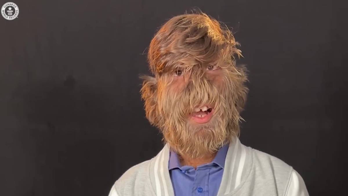 Lalit Patidar estava com 18 anos quando foi reconhecido pelo Guinness World Records como o homem mais peludo do mundo. Foto: Reprodução/Youtube/Guinness World