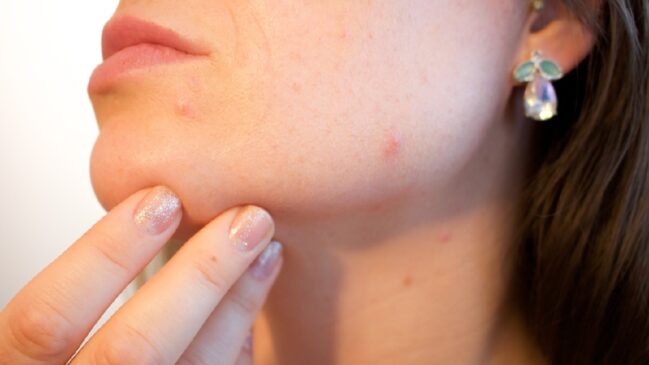 Acne pode aparecer por diversos motivos, muitos deles bastante simples de corrigir.