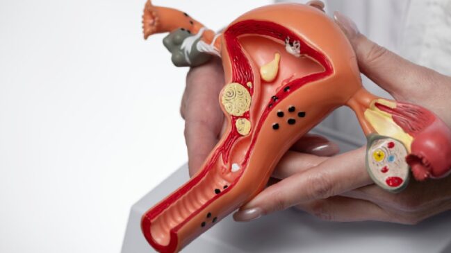 A endometriose é uma doença crônica e benigna onde o tecido semelhante ao endométrio (que reveste o útero) cresce fora do útero, geralmente na cavidade pélvica ou abdominal