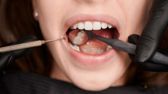 Falta de cuidados com a boca pode levar à perda dentária e até afetar a saúde geral