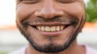Os dentes amarelos não são dessa cor apenas por falta de higiene, entenda o porquê
