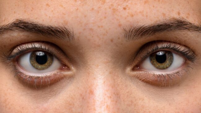 A mioquimia palpebral é comum e geralmente aparece em momentos de estresse ou cansaço