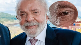 A cirurgia de catarata está entre as mais feitas no Brasil e costuma ter alta no mesmo dia