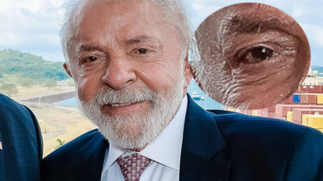 A cirurgia de catarata está entre as mais feitas no Brasil e costuma ter alta no mesmo dia