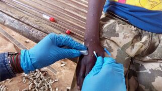 Estado já registrou mais de 6 mil casos confirmados de Mpox desde 2022