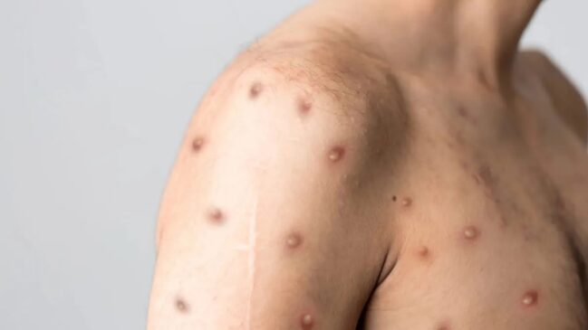 A doença se trata de uma infecção viral transmitida por contato íntimo ou por proximidade com a pessoa acometida