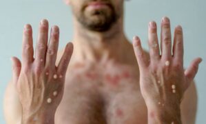 A erupção na pele pode ser o primeiro sinal: entenda os sintomas da mpox, a evolução das lesões e cuidados para evitar transmissão.