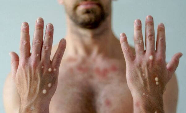 A erupção na pele pode ser o primeiro sinal: entenda os sintomas da mpox, a evolução das lesões e cuidados para evitar transmissão.