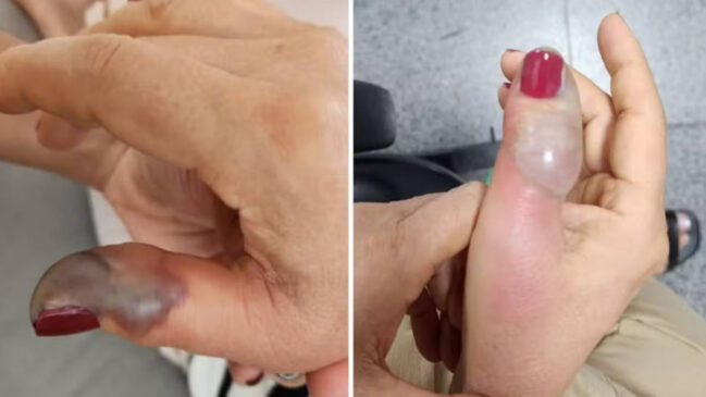 Fotos da mão de Marise Teixeira dois dias depois de fazer a unha e no dia da primeira cirurgia, em 2025