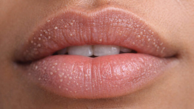 A condição não é contagiosa e não guarda nenhuma relação com herpes labial, HPV, verrugas genitais ou HIV.