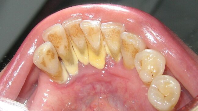Especialistas afirmam que essa estratégia não se limita a eliminar bactérias prejudiciais, mas busca restaurar o equilíbrio da microbiota oral e reconstruir um ecossistema saudável