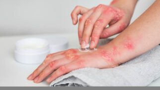 Lesões na pele são um dos principais sinais da Mpox, doença viral que pode provocar complicações em grupos de risco.