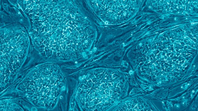 Ciência japonesa promete revolucionar tratamento de casos de Parkinson no mundo