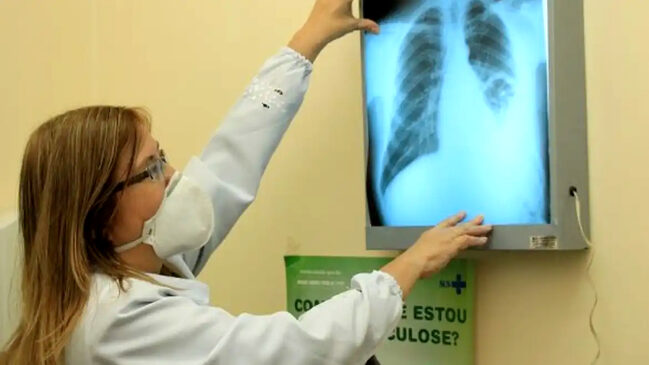 Secretaria de Saúde de Porto Feliz realiza até o próximo dia 31 deste mês a Campanha de Intensificação de Busca Ativa de Tuberculose em todas as Unidades Básicas de Saúde (UBSs) do município