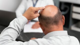 Genes ligados à calvície perderam força ao longo de milênios, indica análise