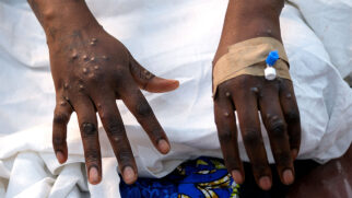 Aumento de casos de mpox acendem alerta no Brasil