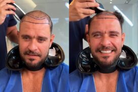 Diogo Nogueira faz transplante capilar e assume nova fase no visual em vídeo