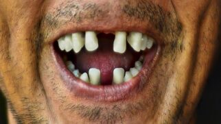 Caso encontrado na Escócia ajuda a entender como pessoas tentavam lidar com dentes perdidos muito antes dos consultórios modernos