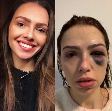 A vendedora Tatiany Arci, de 31 anos, agredida em balada em SP