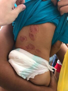 O bebê tinha ao menos 15 marcas de mordidas pelas costas, orelhas, barriga e rosto, segundo a mãe; caso ocorreu na quarta